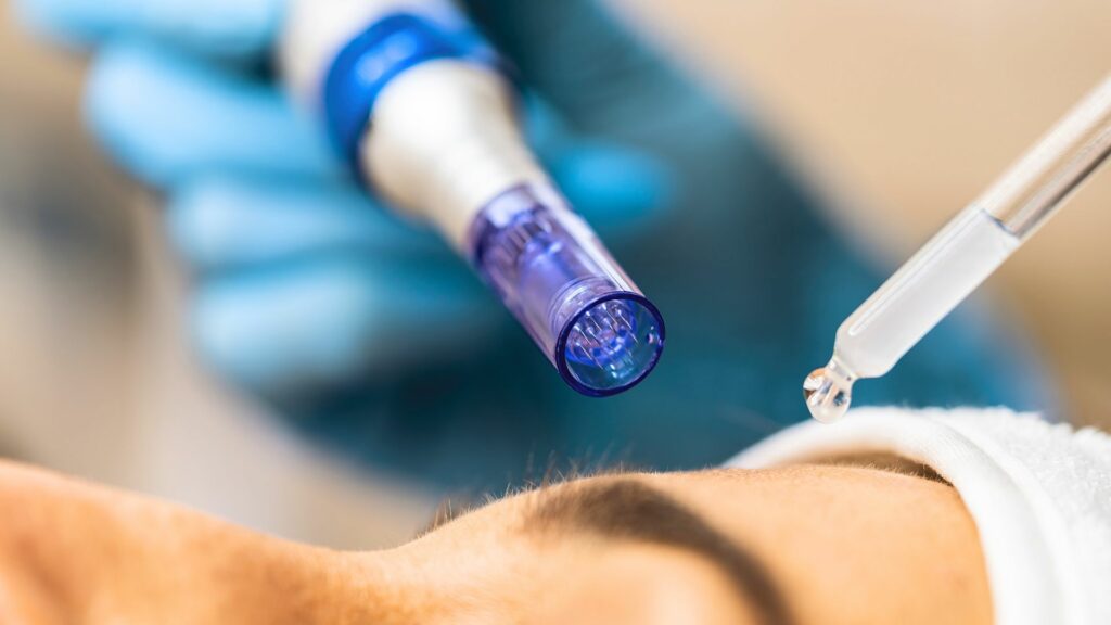 Traitement par Microneedling à la clinique CLEM de Lille et Arras